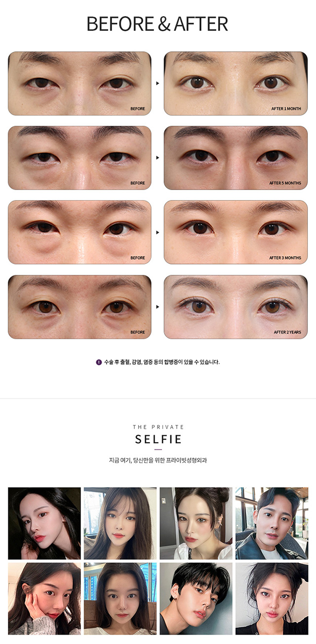 눈밑지방재배치